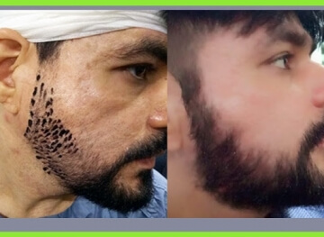 Beard & Mustache Transplant in Mumbai