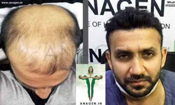 Hair Loss Treatment in Mumbai