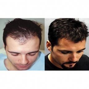 Mens Hair Restoration in Mumbai