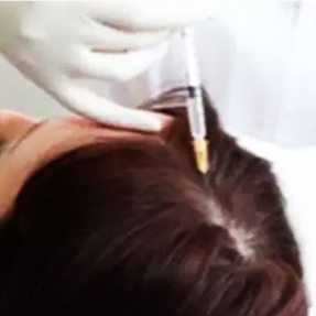 Mesotherapy For Hair Loss in Mumbai 
